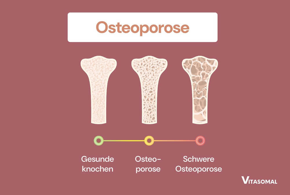 Vitamin K - Osteoporose