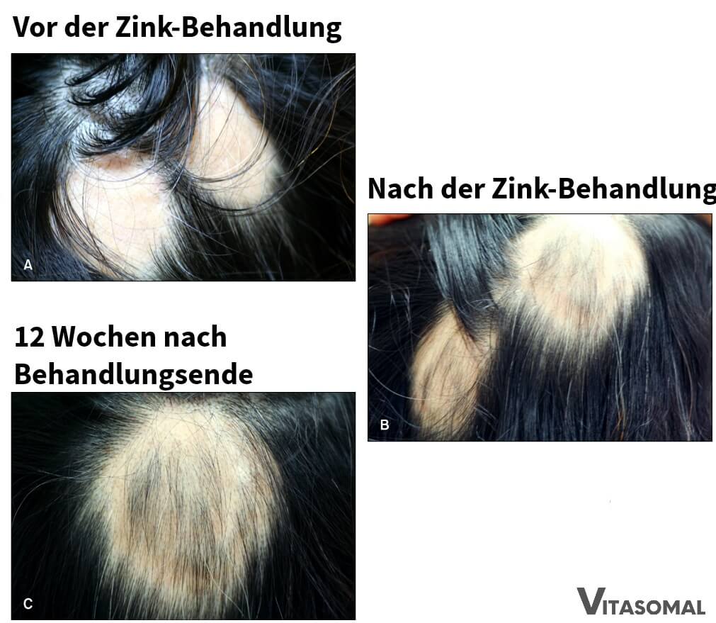 Zink Haarausfall