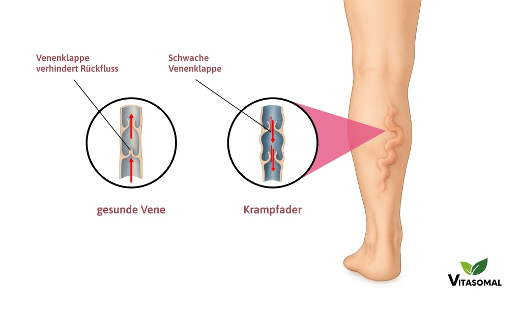 krampfadern-venenwunder-entstehung