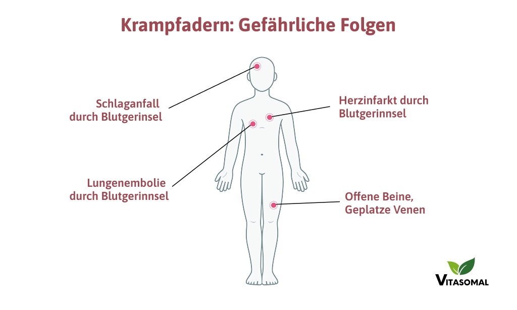 krampfadern-venenwunder-gefaerliche-folgen